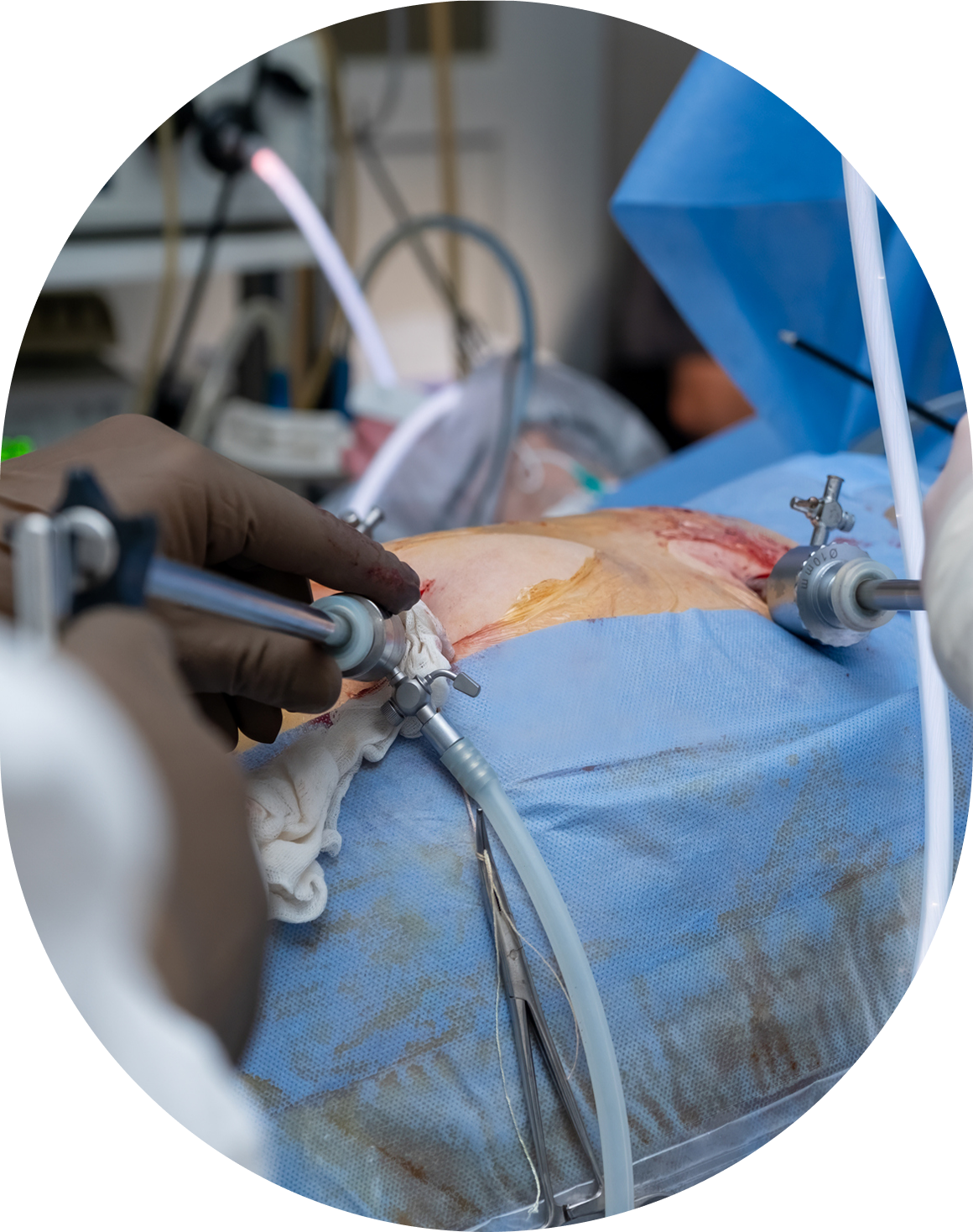 Close-up of laparoscopic surgery in progress